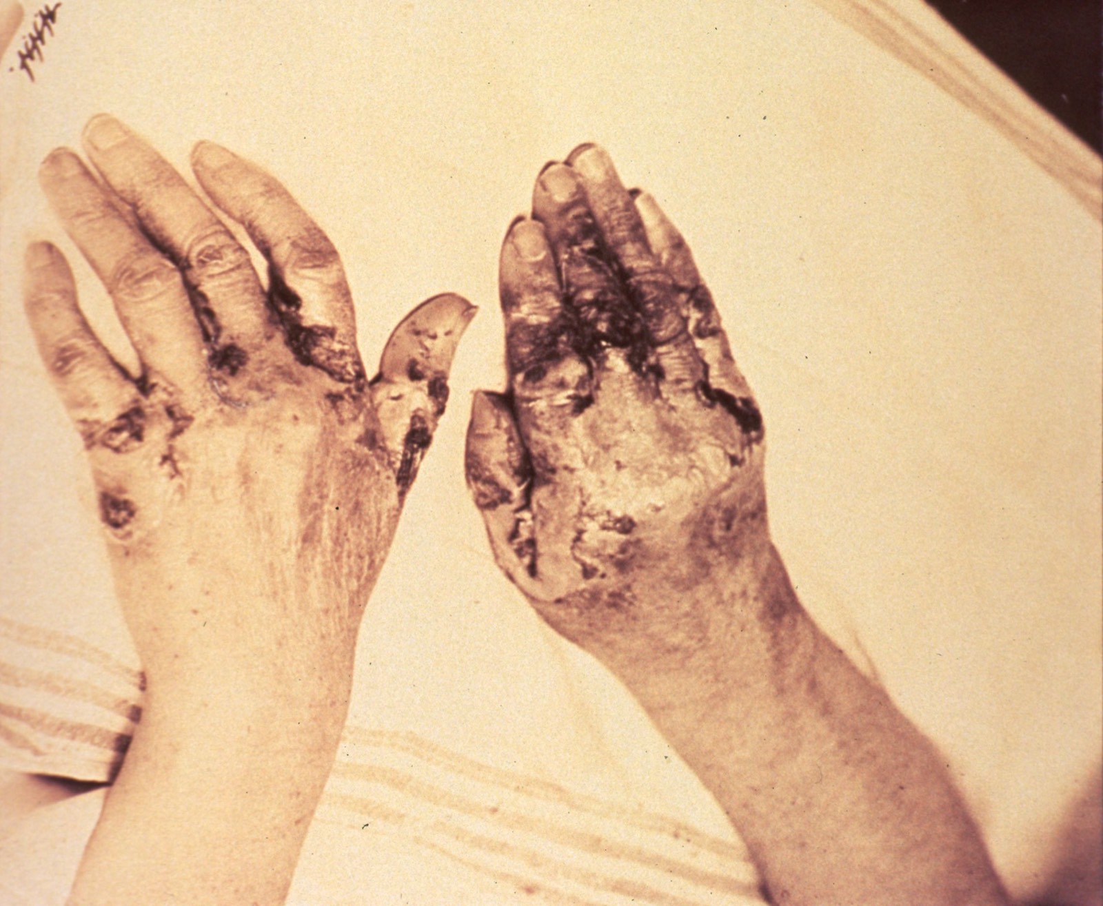The backs of two hands on a white sheet, the skin dark, cracked and peeling in symmetrical patches from the knuckles to the wrists